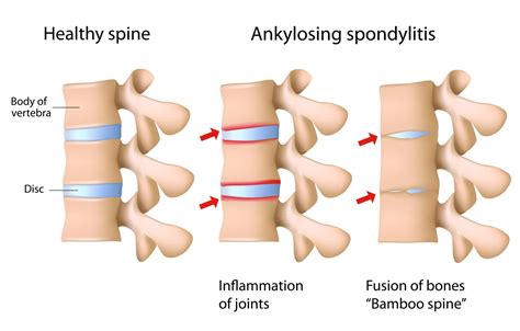 What Is Bamboo Spine New Jersey Comprehensive Spine Care