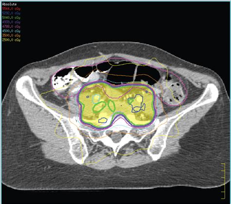 The Emerging Use Of Imrt For Treatment Of Cervical Cancer In Journal