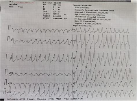 Ventricular Tachycardia Download Scientific Diagram