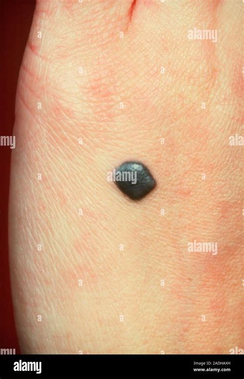 Malignant Melanoma Nodular Type An Aggressive Form Of Skin Cancer