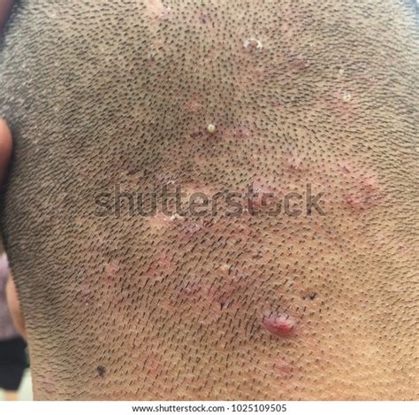 Acne On Scalp Stock Photo 1025109505 | Shutterstock