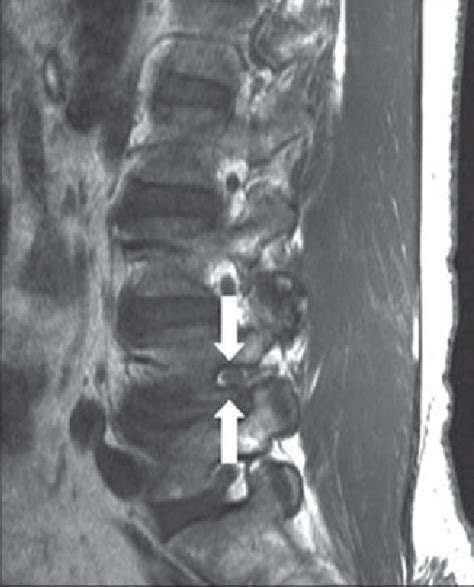 Foraminal Narrowing Mri