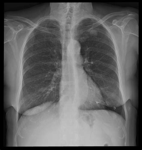 Chest Xray Cancer