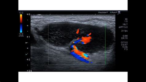 Ultrasound Of A Benign Inflamed Lymph Node Youtube