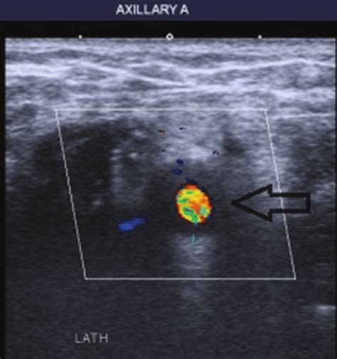 Halo sign on axillary artery ultrasound | Download Scientific Diagram