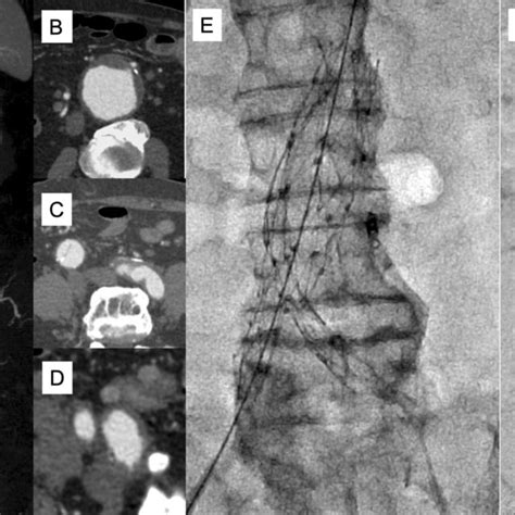 Case 1 A C Preoperative Computed Tomography Ct Imaging A Ct