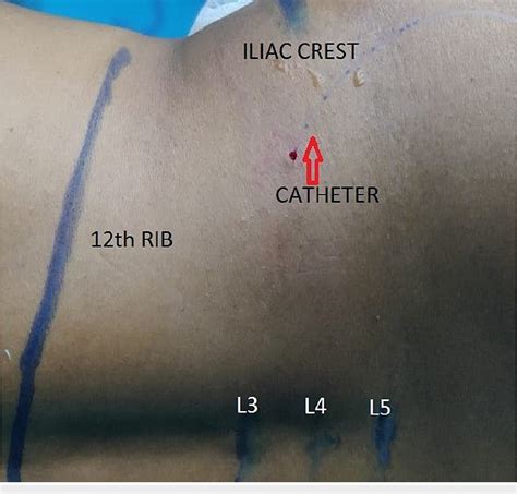 Figure 2 From Ultrasound Guided Continuous Transmuscular Quadratus