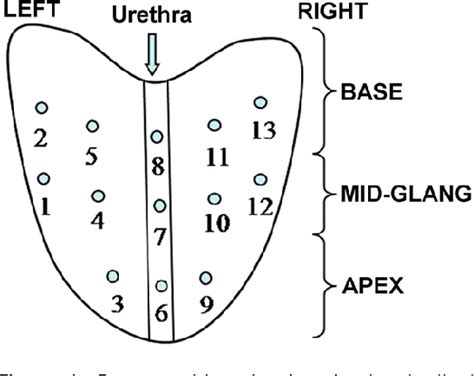 PDF Different TPSA And Prostate Volume Detection Of Prostate Cancer