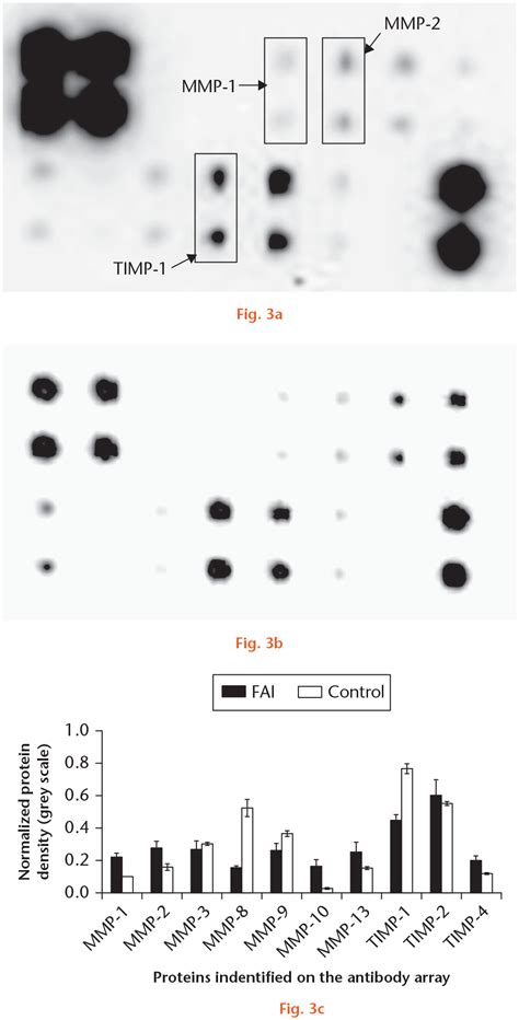 Expression Profile Of Matrix Metalloproteinases In The Labrum Of