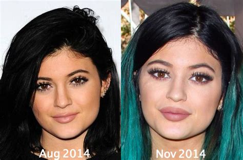 Kylie Jenner Plastic Surgery Before And After Eyebrows