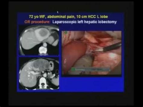 Right Hepatectomy David Galler Md Youtube