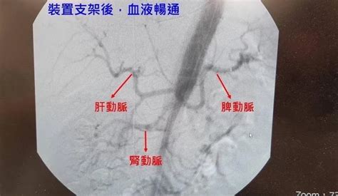 43歲男子肚子劇痛 就醫一看竟然是「主動脈剝離」惹禍！ 中天新聞網