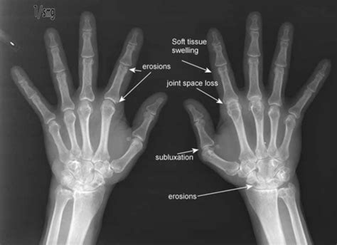 Rheumatoid Arthritis Flashcards Quizlet