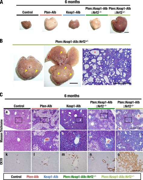 Development Of Polycystic Fibrosis In Ptenkeap1 Albnrf2 Mice At