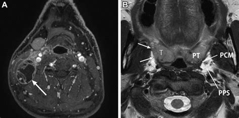 Imaging Approach For Cervical Lymph Node Metastases From Unknown