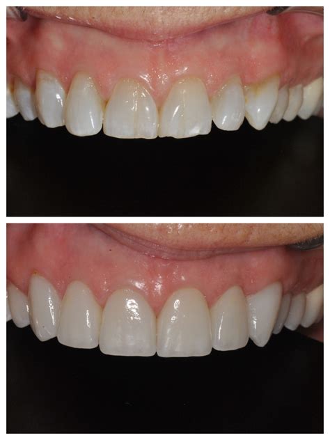 Porcelain Dental Crown Single Front Tooth Crown Before And After