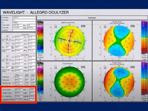 Corneal topography | PPT