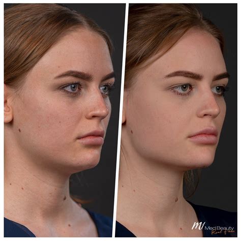 Jawline Filler Jawline Augmentation With Dermal Filler M1 Med Beauty