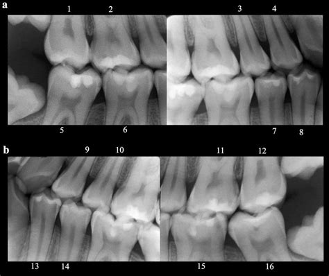 Bitewing Radiograph