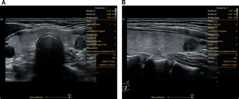 Frontiers S Thyroid Computer Aided Diagnosis Ultrasound System Of