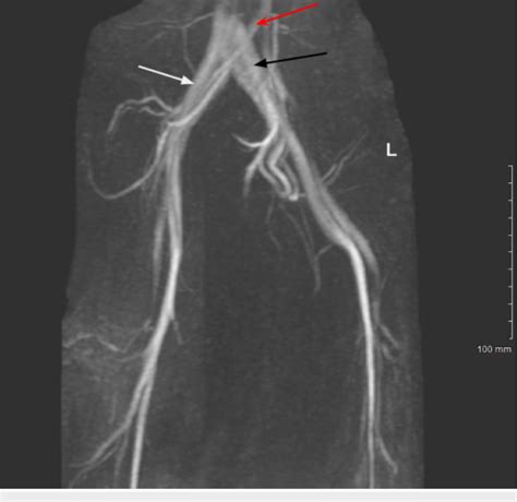 Magnetic Resonance Venography Of The Pelvic Vasculature Demonstrating Download Scientific