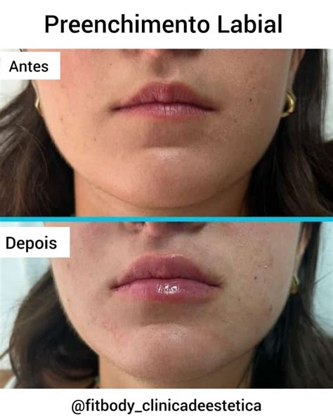 Preenchimento Labial Como é Realizado Clínica Fit Body Estética