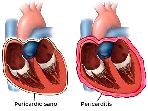 Pericarditis Síntomas Causas y Tratamiento Diagnóstico Rojas