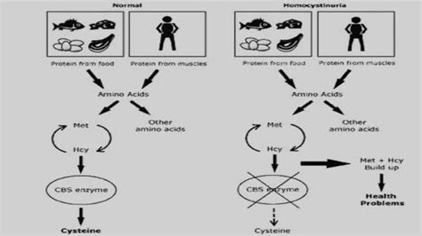 Homocystinuria | PPT