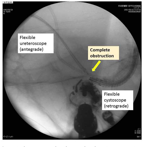 Figure 1 From Combined Antegrade And Retrograde Endoscopic Treatment Of