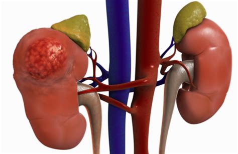 Kidney Disease