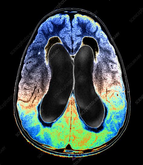 Medulloblastoma Mri Stock Image C Science Photo Library