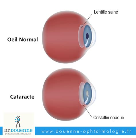 Cataracte