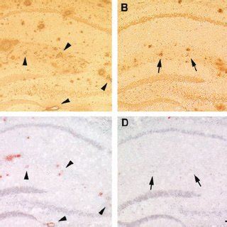 Vascular And Parencymal Amyloid Burden Are Both Markedly Decreased By