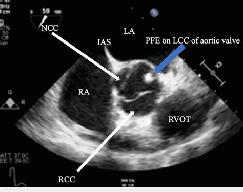 Midesophageal View Of The Tee Showing The Papillary Fibroelastoma On Download Scientific