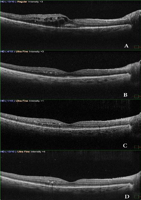 Oct Scans Show A Cystic Macular Edema With Subretinal Fluid B 24