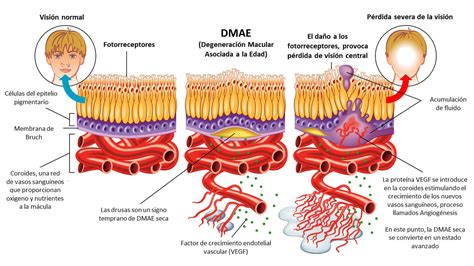 Degeneraci N Macular Asociada A La Edad Dmae Qu Es S Ntomas