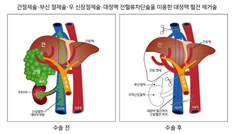 부산 온종합병원 간담췌암 수술 213건 달성