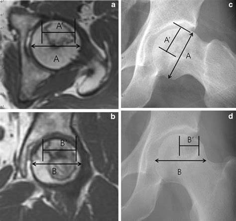 The Natural History Of Asymptomatic Osteonecrosis Of The Femoral Head Pmc