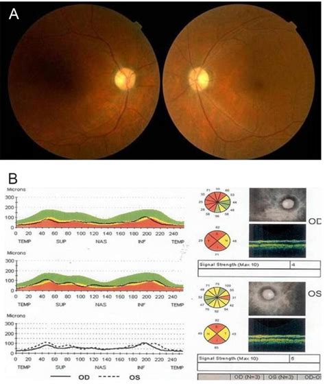 (A) Optic nerve disc edema in both eyes and peripapillary flame-shaped ...