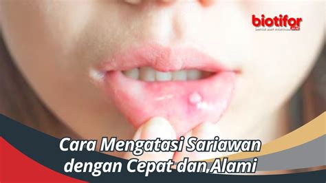 Cara Mengatasi Sariawan Dengan Cepat Dan Alami Biotifor