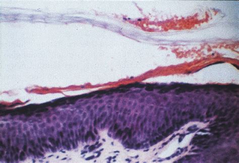 Staphylococcal Scalded Skin Syndrome Histology