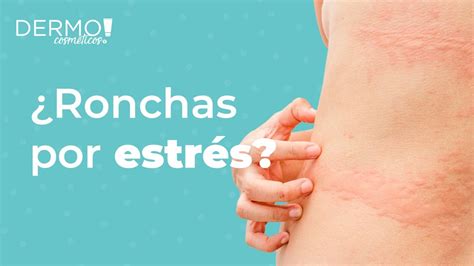 Urticaria Por Estr S San Pablo Dermo Youtube