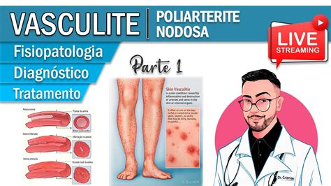 Poliarterite Nodosa Fisiopatologia Das Vasculites Parte 1 YouTube