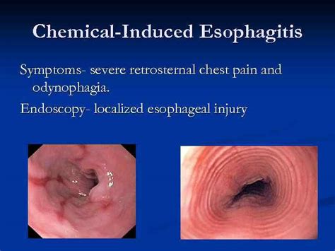 Gastro Oesophageal Reflux Disease Gord Differential Diagnosis Gord