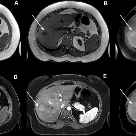 Year Old Patient Referred For Liver Lesion Characterization Liver