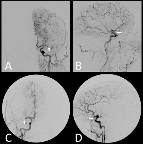 Conventional Angiography Findings Of The Patients Shown In Fig 1 And