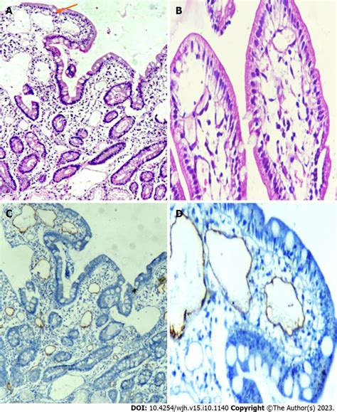 Histological Examination Of Second Part Of Duodenum Biopsy Specimens