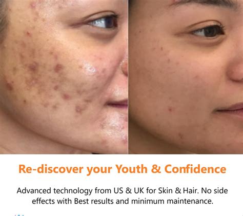 Acne Acne Scars Open Pores Pigmentation Dark Circles Treatment