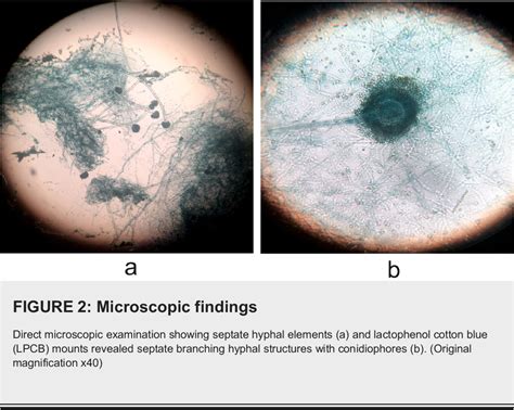 Figure 2 from Aspergillus flavus Infection of Lower Limb in an Immune-Competent Patient ...