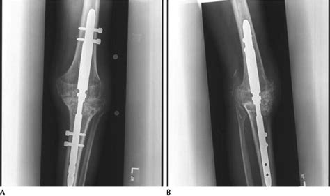 Salvage Knee Surgery: Arthrodesis | Musculoskeletal Key